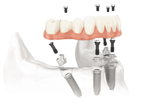 Comprehensive Dental Implant Prosthetics Training for Dentists